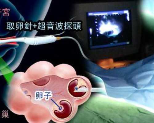 供卵专业医院排名_供卵生子中心_为什么做试管一定要养囊,试管养囊费用是多